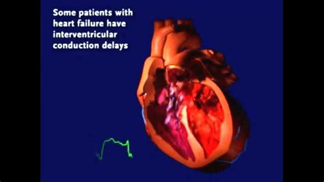 ventricular dyssynchrony life expectancy